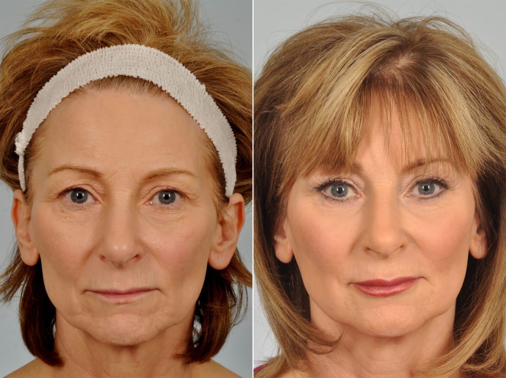 Laser Skin Resurfacing Before & After Photos | W Cosmetic Surgery