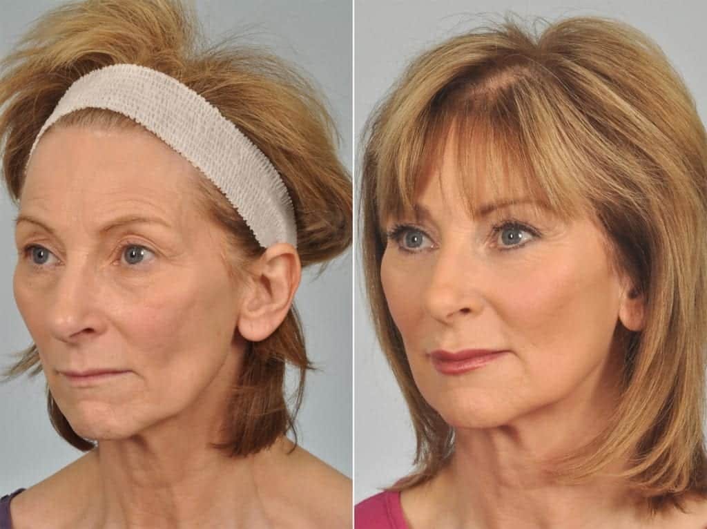 Laser Skin Resurfacing Before & After Gallery - Patient 399067 - Image 2