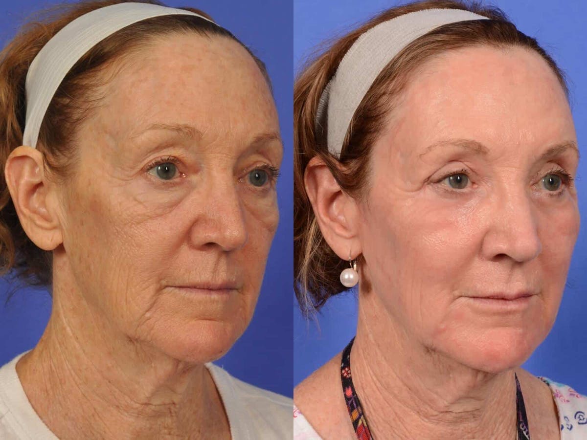 Laser Skin Resurfacing Before & After Gallery - Patient 299316 - Image 3