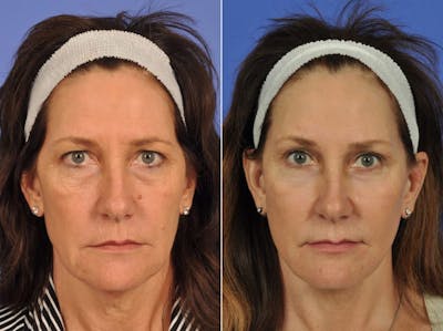 Laser Skin Resurfacing Before & After Gallery - Patient 218349 - Image 1