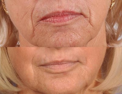 Laser Skin Resurfacing Before & After Gallery - Patient 247743 - Image 1