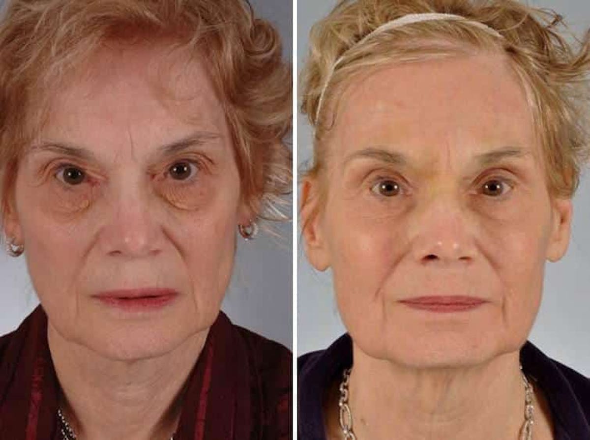 Laser Skin Resurfacing Before & After Gallery - Patient 990865 - Image 1