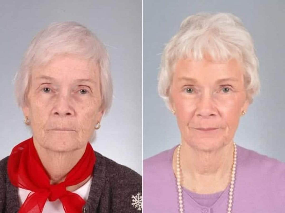 Laser Skin Resurfacing Before & After Gallery - Patient 177851 - Image 1