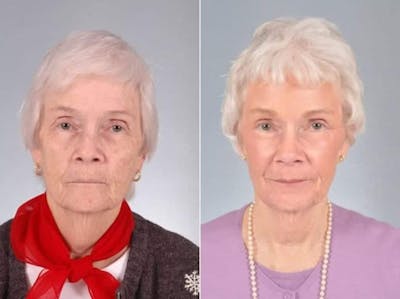 Laser Skin Resurfacing Before & After Gallery - Patient 177851 - Image 1