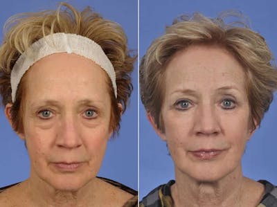 Laser Skin Resurfacing Before & After Gallery - Patient 312359 - Image 1