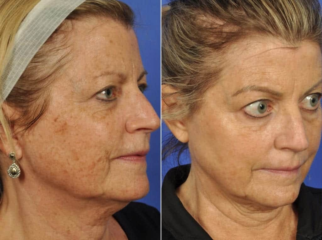 Laser Skin Resurfacing Before & After Gallery - Patient 183278 - Image 2