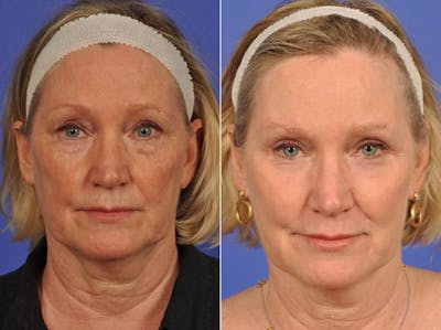 Laser Skin Resurfacing Before & After Gallery - Patient 415963 - Image 1