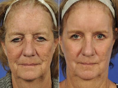 Laser Skin Resurfacing Before & After Gallery - Patient 244122 - Image 1