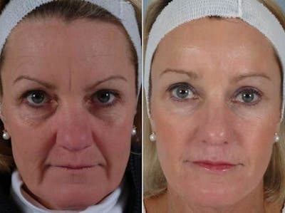 Laser Skin Resurfacing Before & After Gallery - Patient 193339 - Image 1