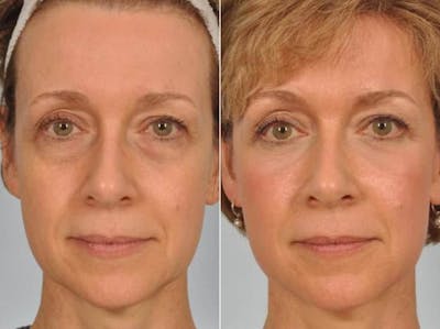 Laser Skin Resurfacing Before & After Gallery - Patient 164597 - Image 1