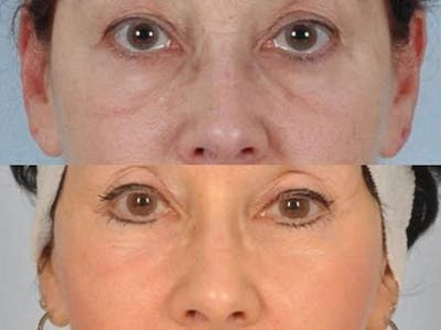 Laser Skin Resurfacing Before & After Gallery - Patient 268551 - Image 1