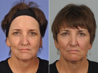 Laser Skin Resurfacing Before & After Gallery - Patient 155217 - Image 1