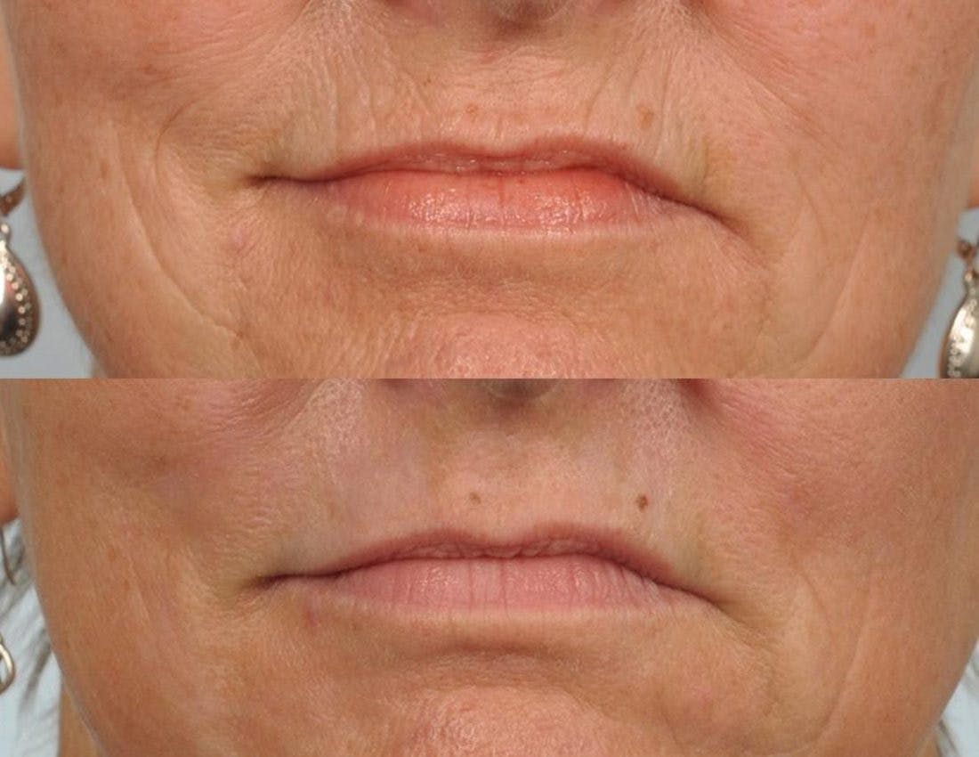 Laser Skin Resurfacing Before & After Gallery - Patient 155217 - Image 2