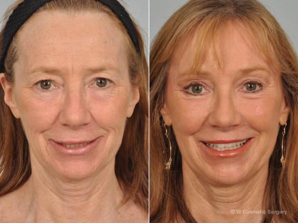 Laser Skin Resurfacing Before & After Gallery - Patient 157705 - Image 1