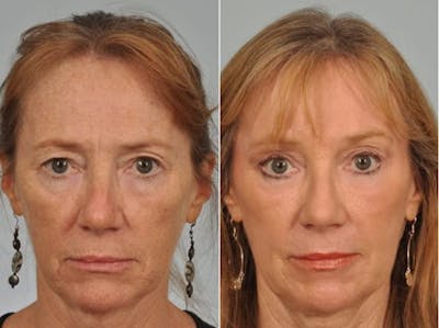 Laser Skin Resurfacing Before & After Gallery - Patient 157705 - Image 2