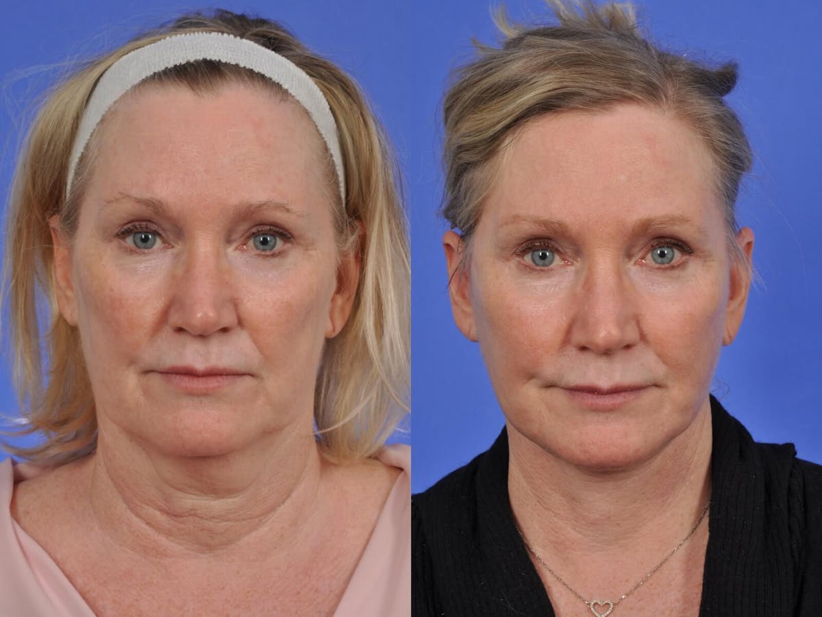 Laser Skin Resurfacing Before & After Gallery - Patient 163328 - Image 1