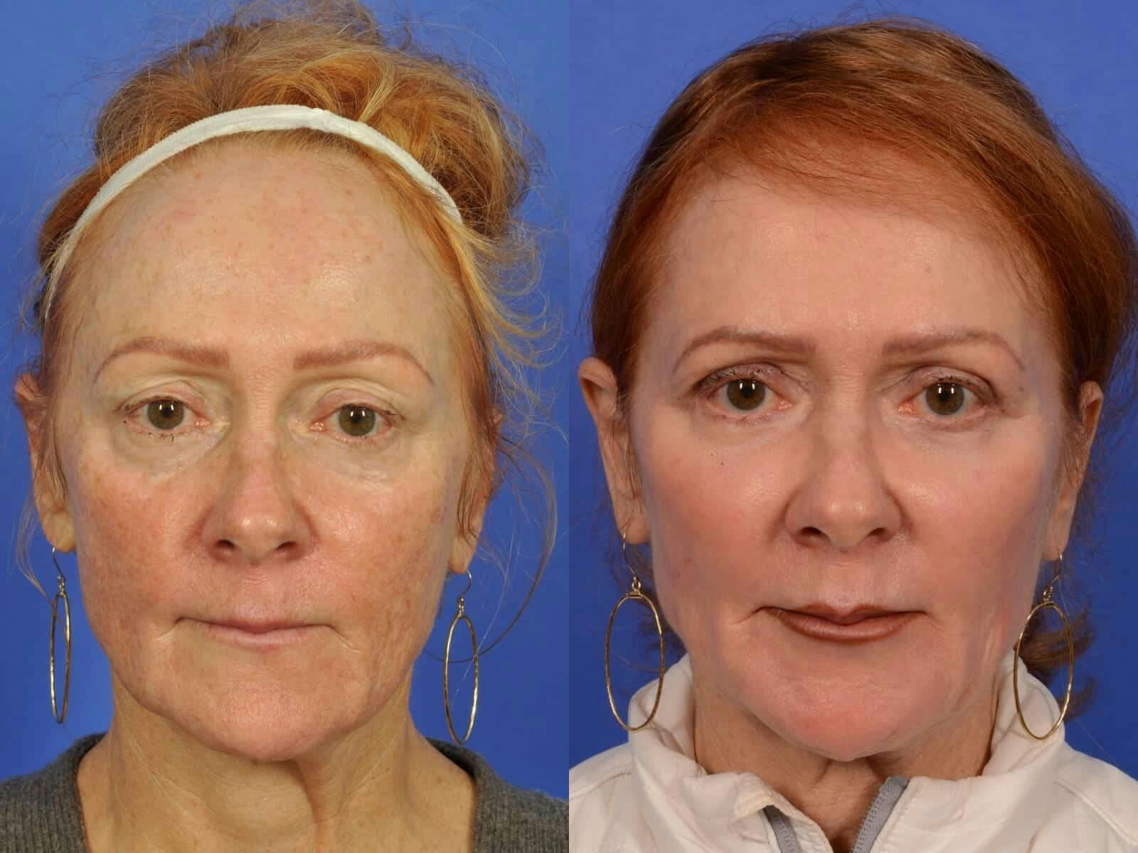 Laser Skin Resurfacing Before & After Gallery - Patient 205887 - Image 1