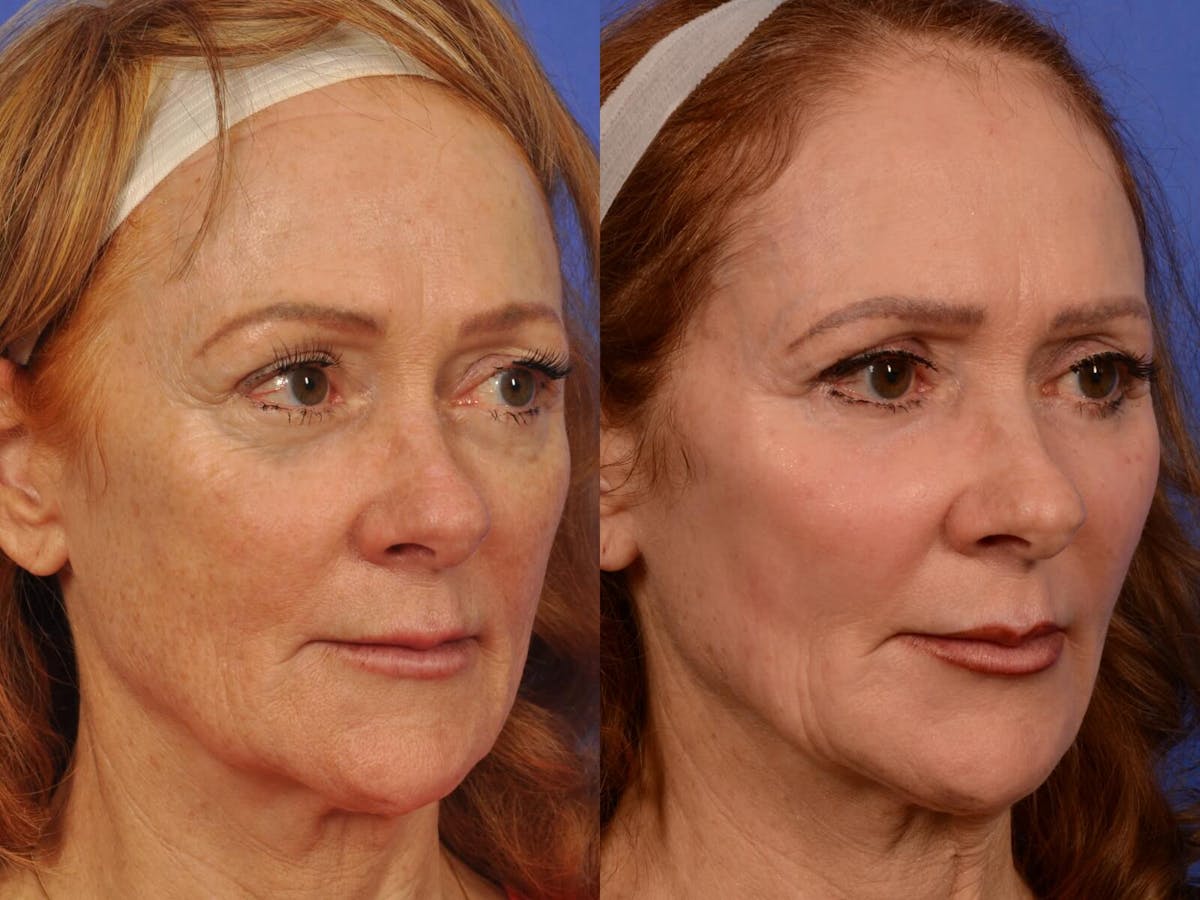 Laser Skin Resurfacing Before & After Gallery - Patient 205887 - Image 2