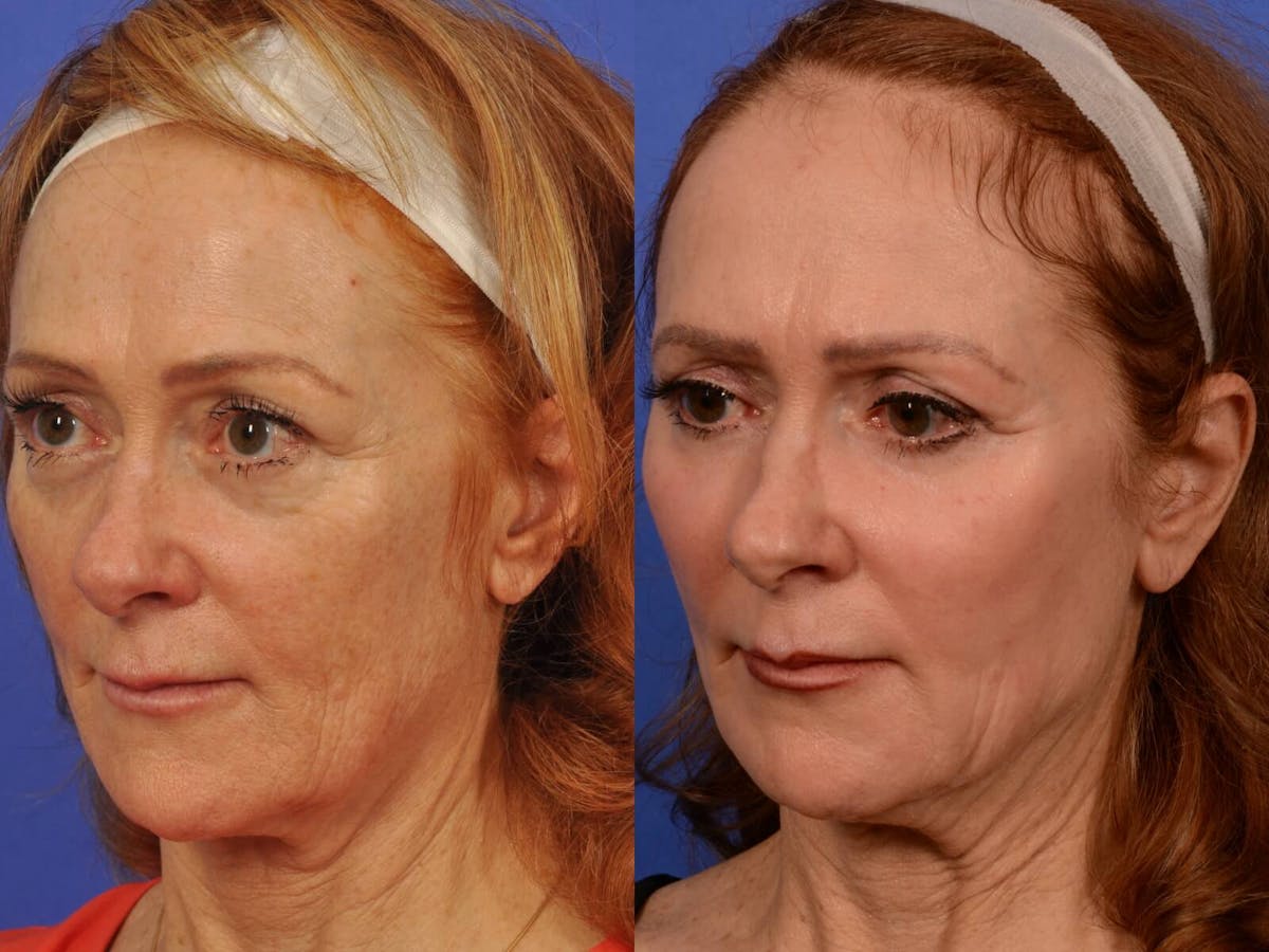Laser Skin Resurfacing Before & After Gallery - Patient 205887 - Image 3