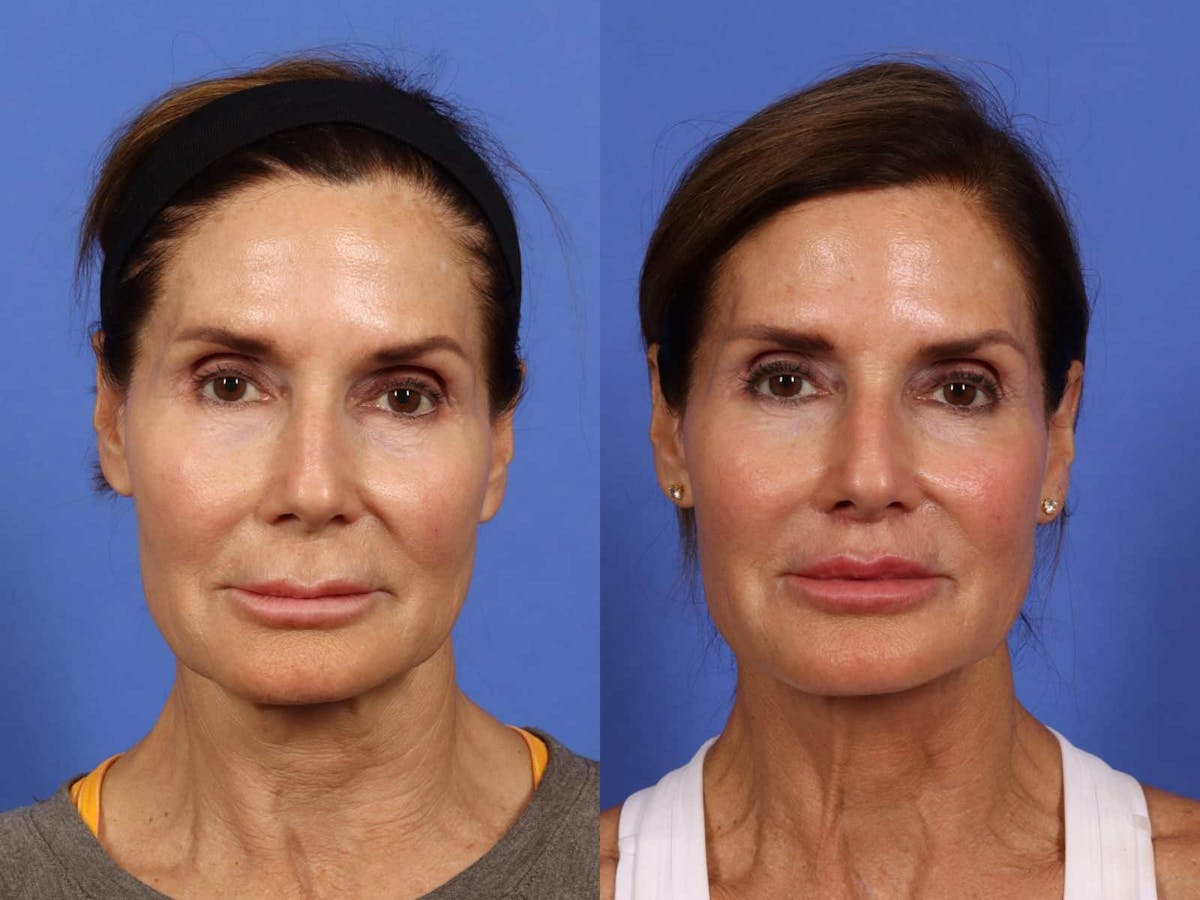 Lip Lift Before & After Gallery - Patient 196887 - Image 1