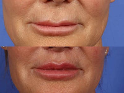Lip Lift Before & After Gallery - Patient 196887 - Image 2