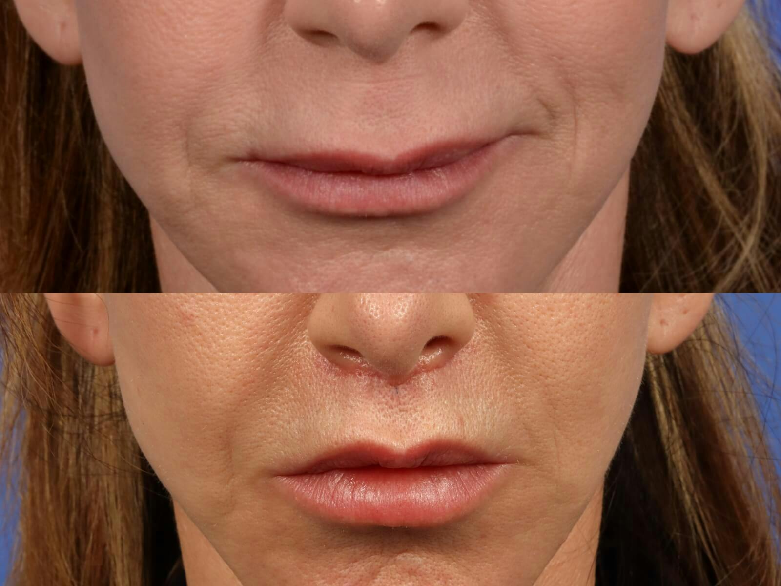 Lip Lift Before & After Gallery - Patient 152457 - Image 2
