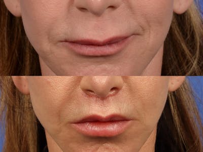 Lip Lift Before & After Gallery - Patient 152457 - Image 2