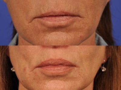 Lip Lift Before & After Gallery - Patient 262835 - Image 1