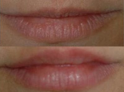 Lip Lift Before & After Gallery - Patient 138205 - Image 1