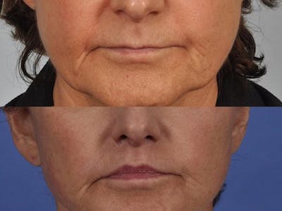 Lip Lift Before & After Gallery - Patient 186121 - Image 1
