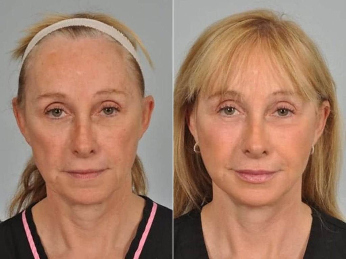 Liposculpture Before & After Gallery - Patient 425384 - Image 1