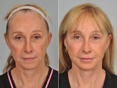 Liposculpture Before & After Gallery - Patient 425384 - Image 1
