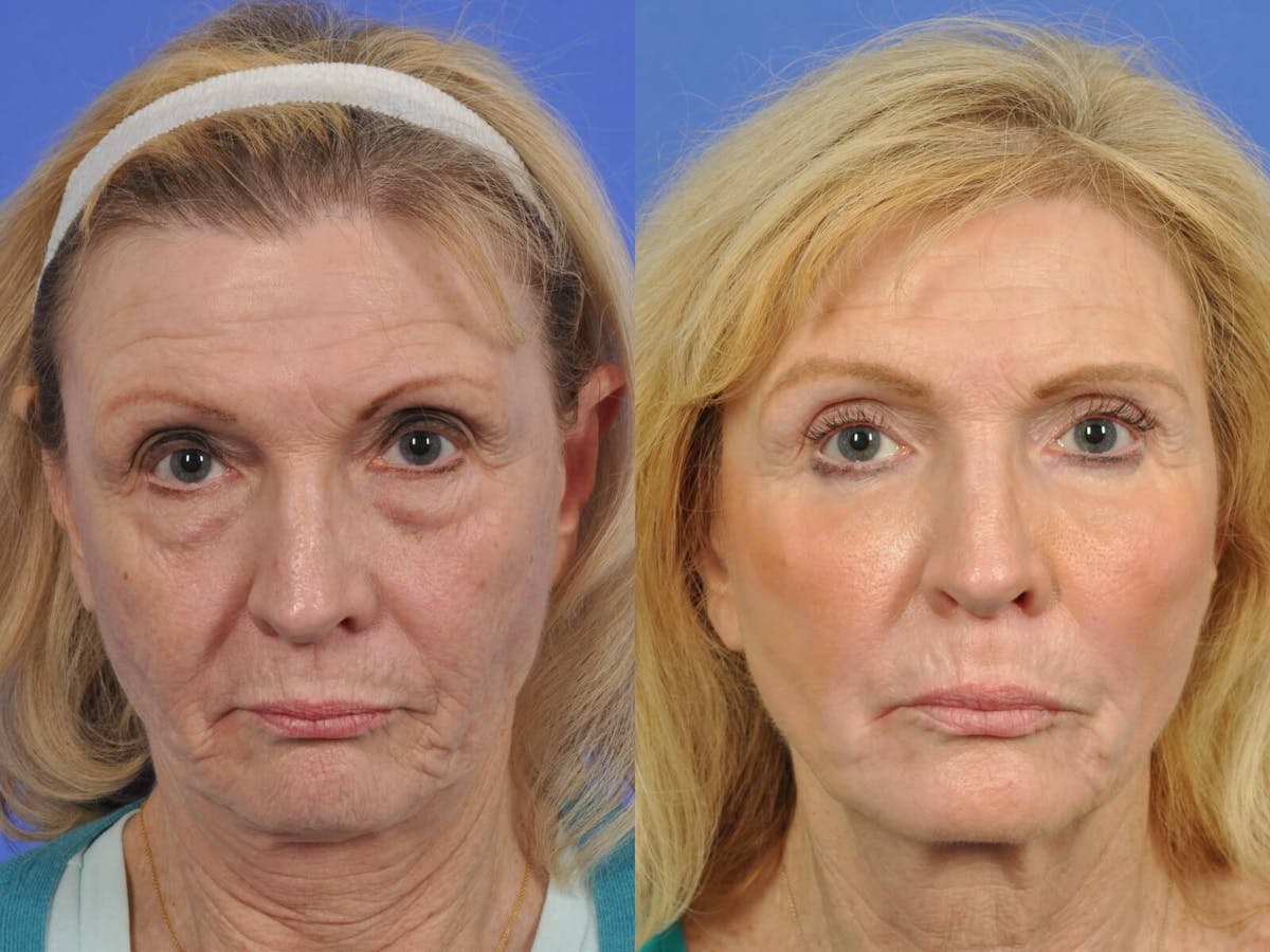 Liposculpture Before & After Gallery - Patient 224978 - Image 1