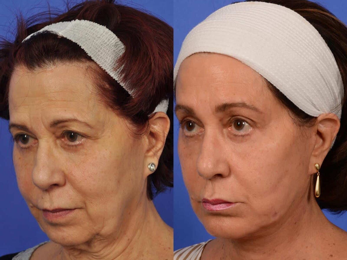 Liposculpture Before & After Gallery - Patient 419915 - Image 2