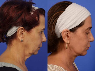 Liposculpture Before & After Gallery - Patient 419915 - Image 5