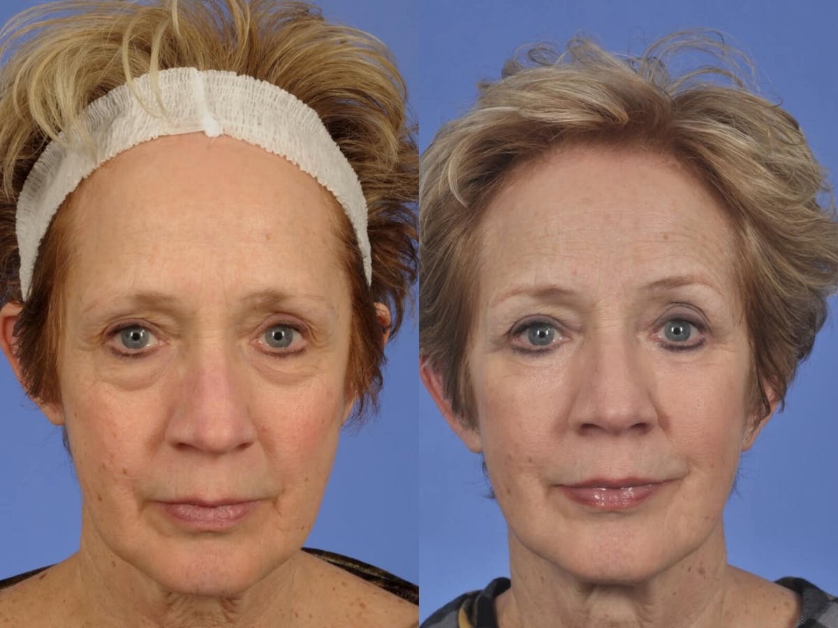 Liposculpture Before & After Gallery - Patient 186763 - Image 1