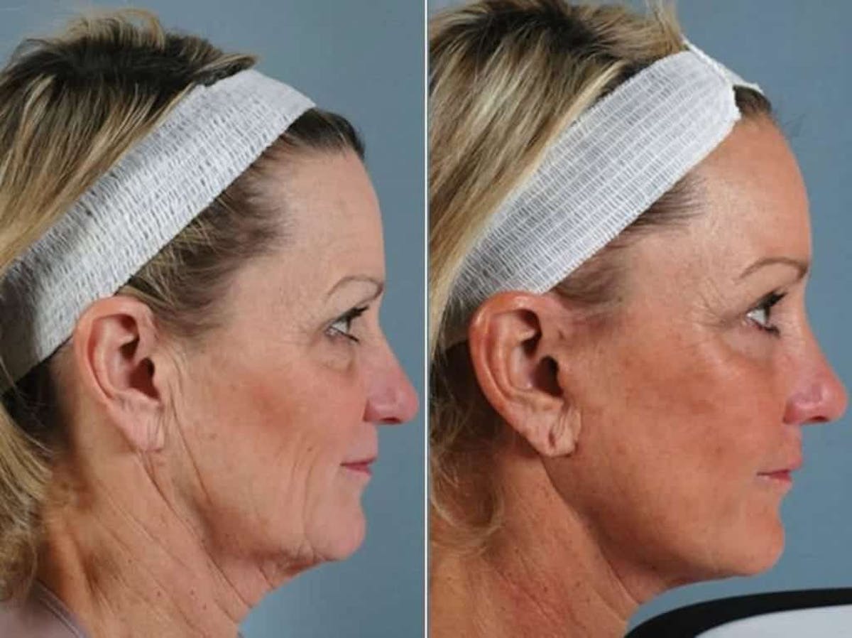 Liposculpture Before & After Gallery - Patient 259340 - Image 4