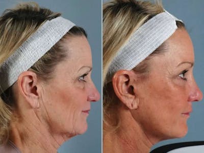 Liposculpture Before & After Gallery - Patient 259340 - Image 4