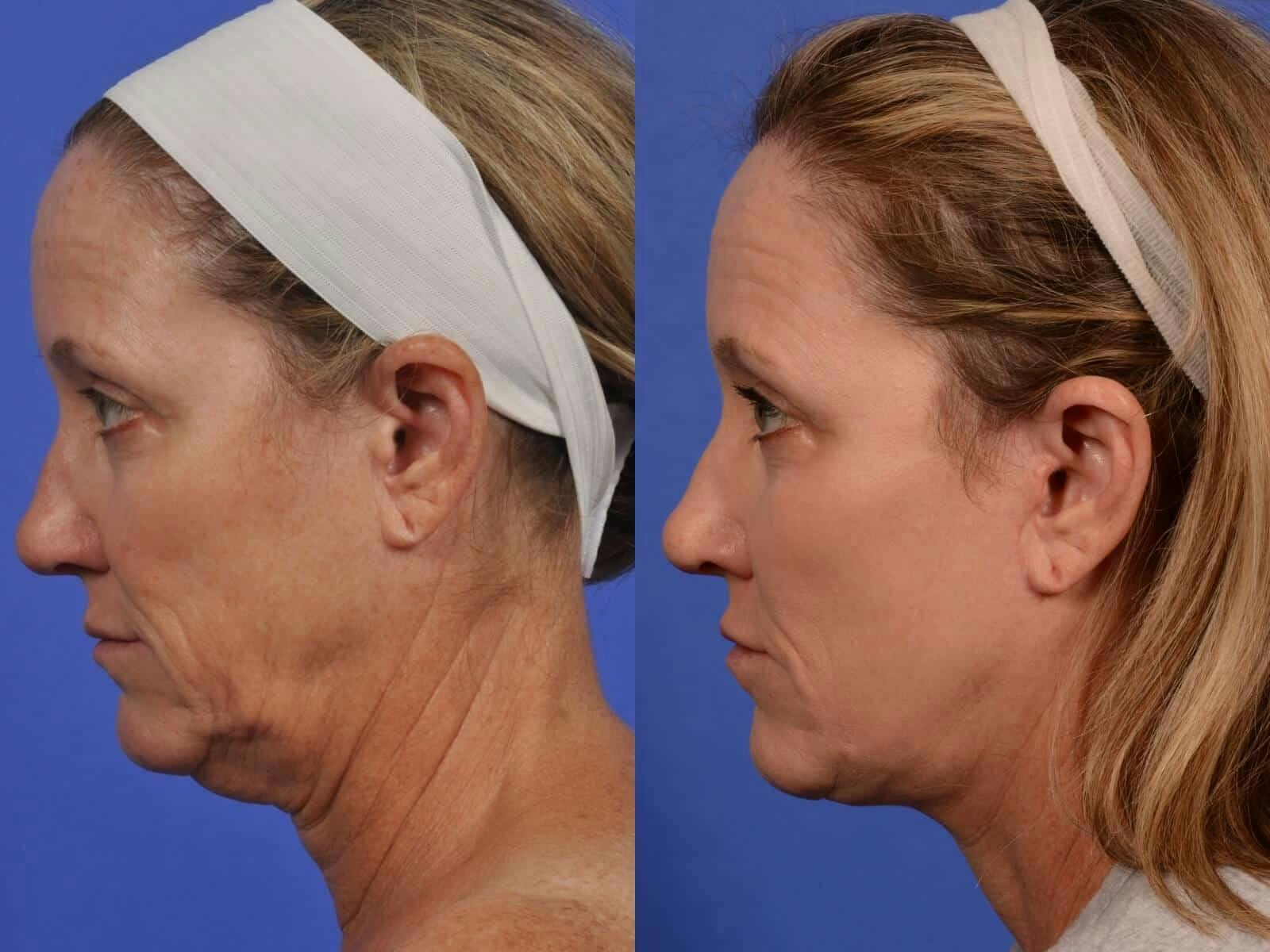 Liposculpture Before & After Gallery - Patient 359844 - Image 5
