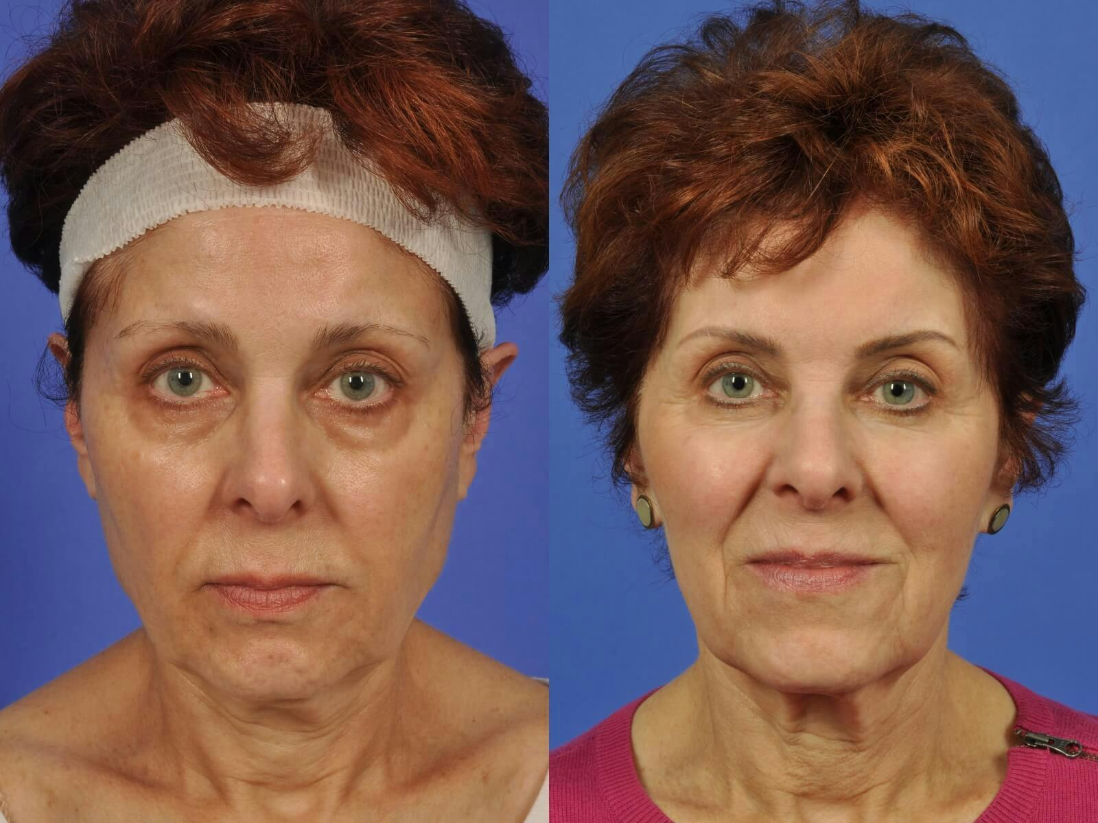 Liposculpture Before & After Gallery - Patient 257288 - Image 1