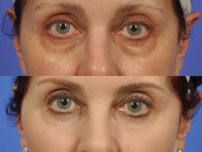 Liposculpture Before & After Gallery - Patient 257288 - Image 2