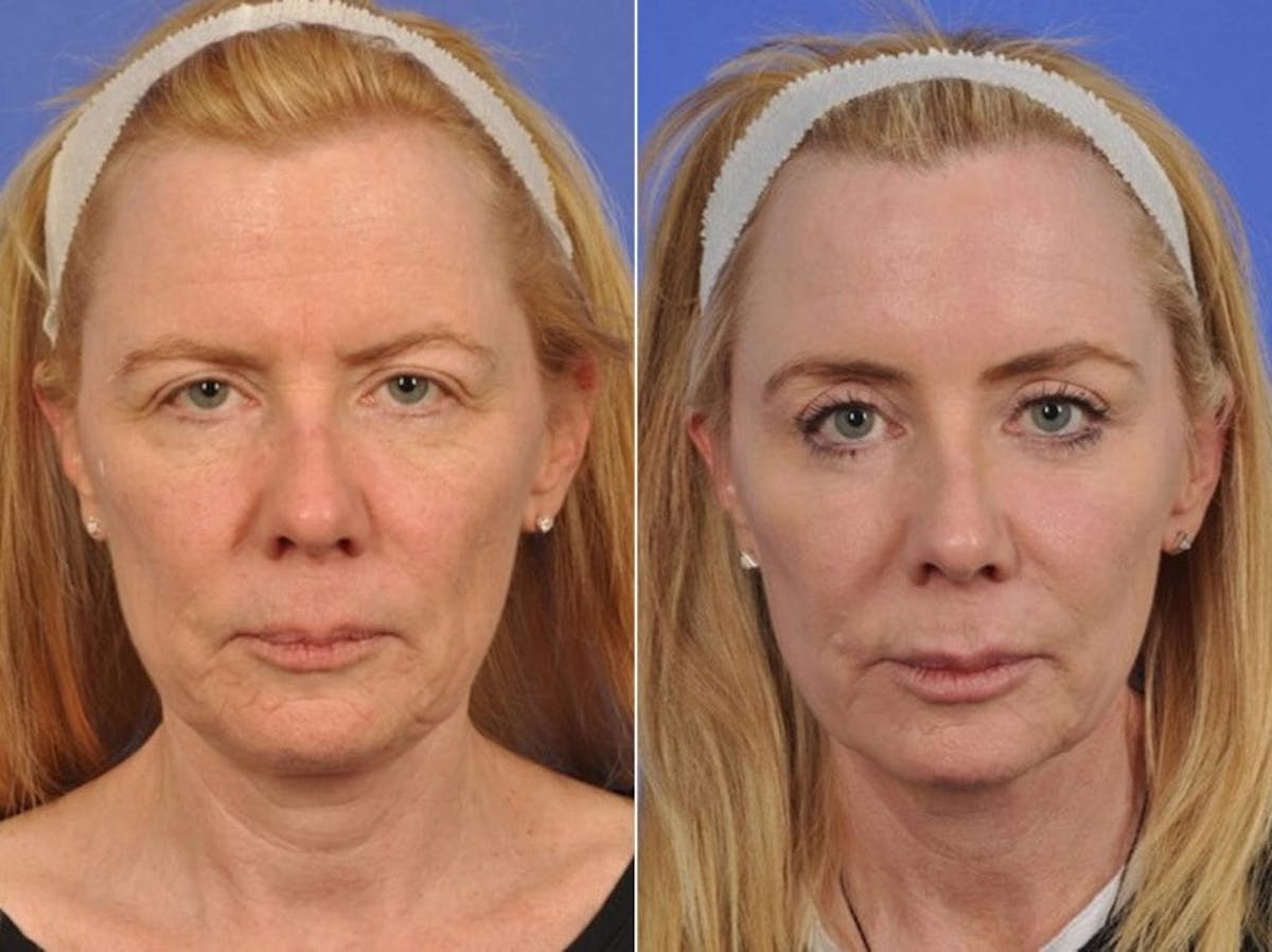 Liposculpture Before & After Gallery - Patient 720950 - Image 1