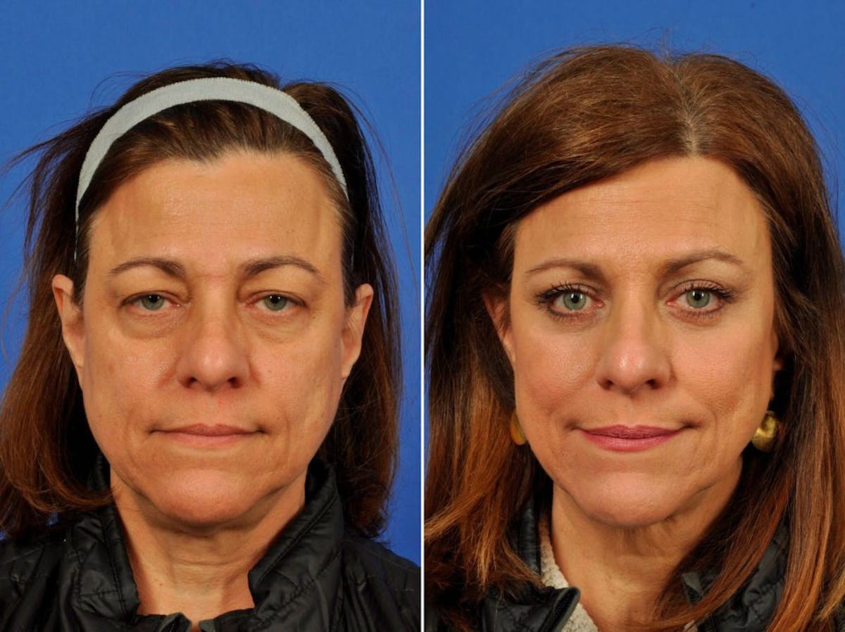 Liposculpture Before & After Gallery - Patient 402349 - Image 1