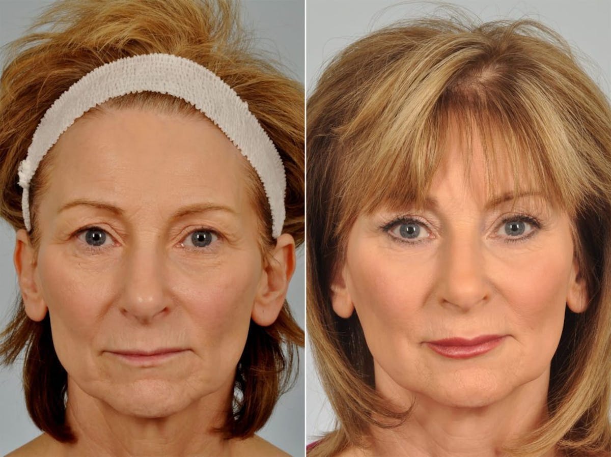 Liposculpture Before & After Gallery - Patient 151751 - Image 1