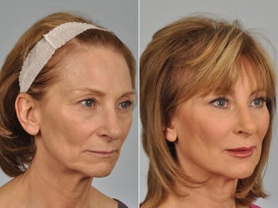 Liposculpture Before & After Gallery - Patient 151751 - Image 3