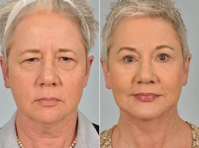Liposculpture Before & After Gallery - Patient 384601 - Image 1