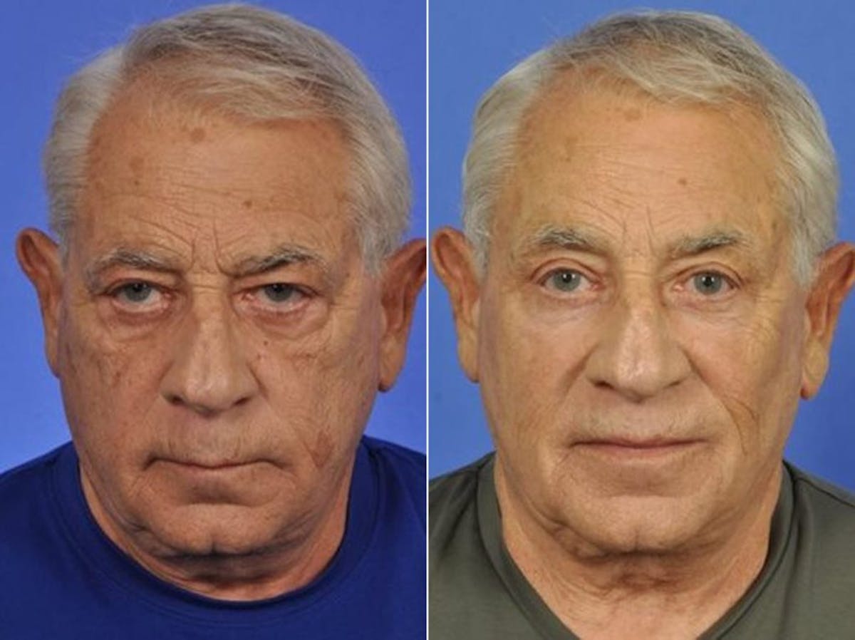 Liposculpture Before & After Gallery - Patient 220580 - Image 1