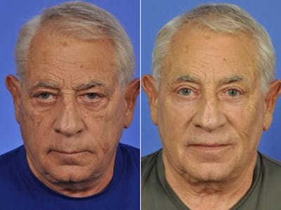 Liposculpture Before & After Gallery - Patient 220580 - Image 1