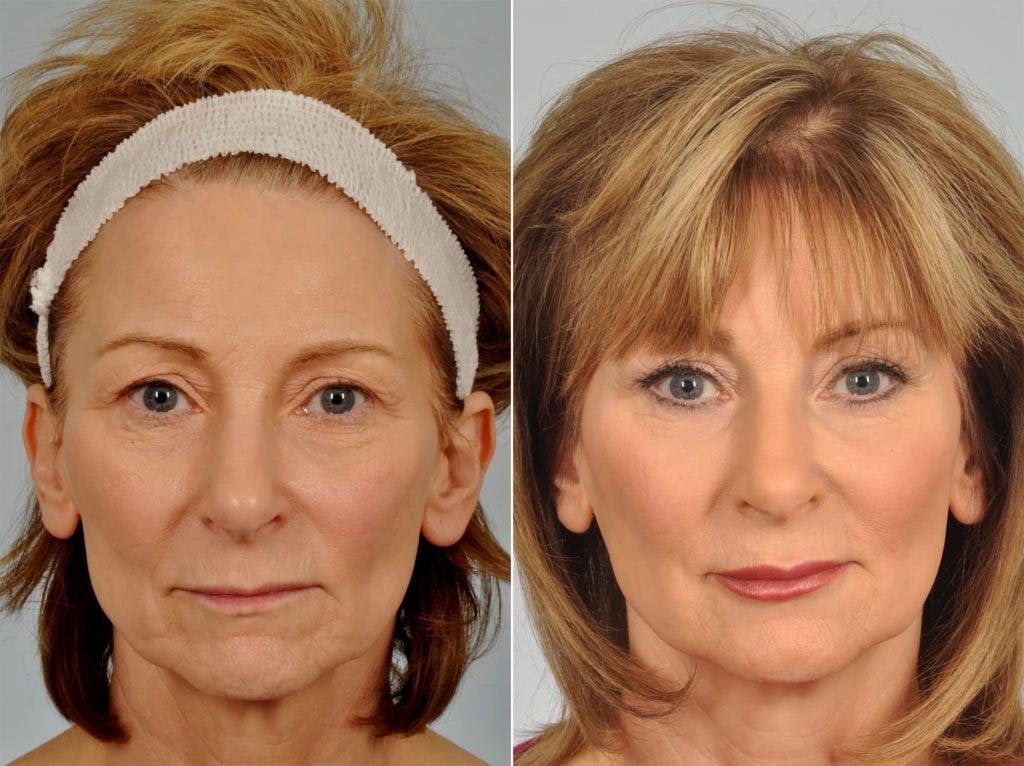 Mid Facelift Before & After Gallery - Patient 826650 - Image 1