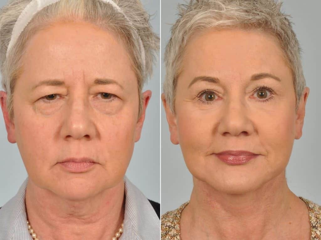 Mid Facelift Before & After Gallery - Patient 353250 - Image 1